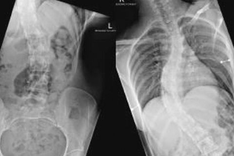 Promieniowanie rentgenowskie klinicznego przypadku Ennovate® w przypadku złożonej skoliozy idiopatycznej u młodzieży