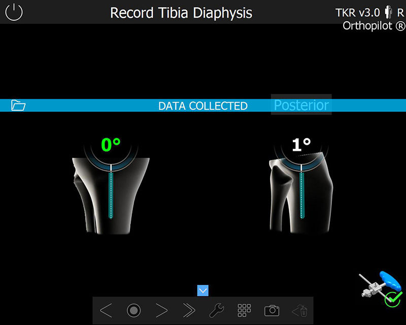 Zrzut ekranu z oprogramowania OrthoPilot® TKR - Record Tibia Diaphysis