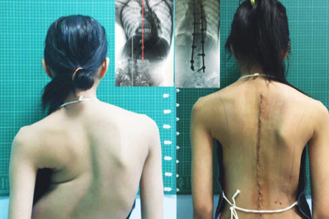 Młoda kobieta przed i po zabiegu Ennovate® PolyLock®