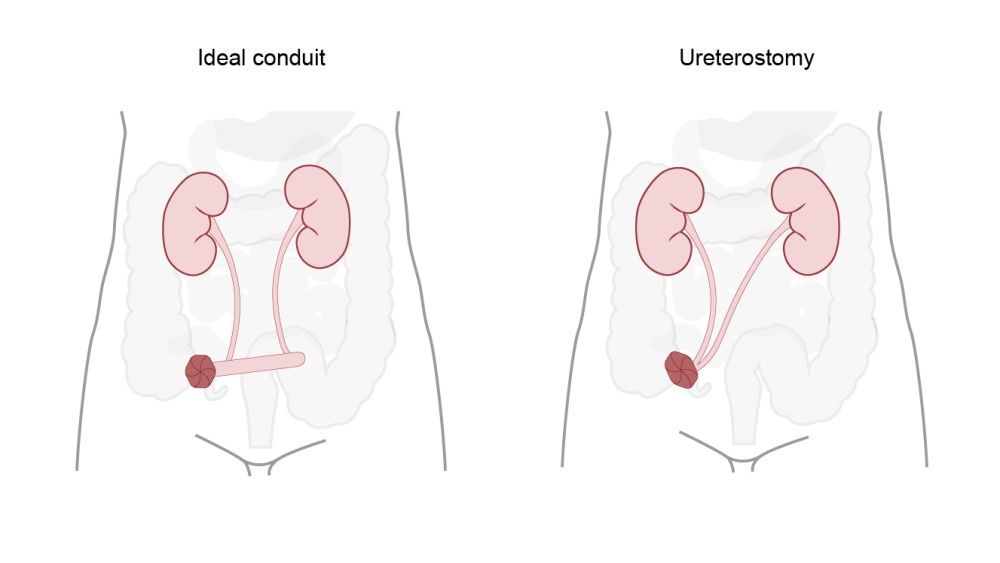 Ilustracja kanału śródbłonowego i ureterostomii