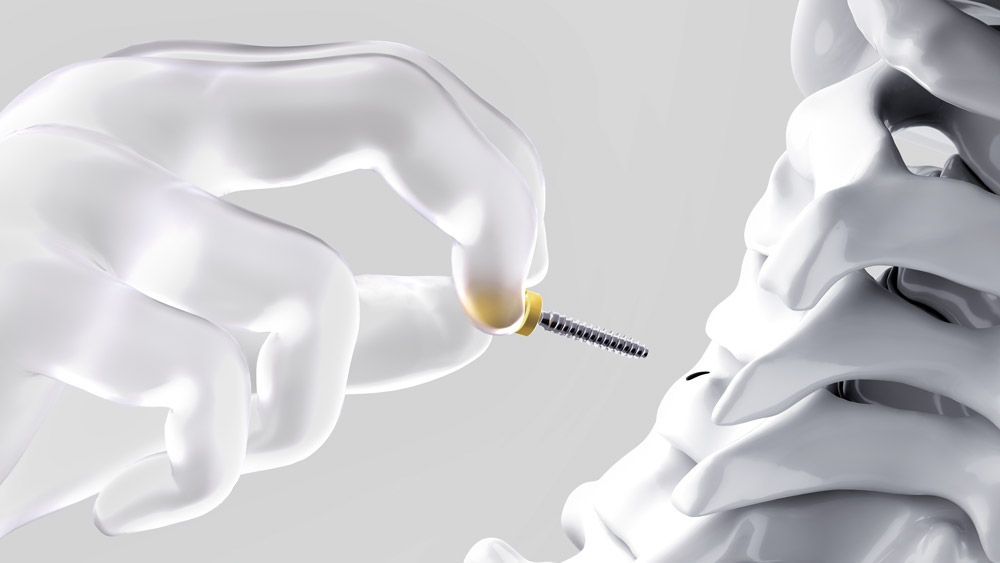  Ilustracja przedstawiająca dłoń trzymającą śrubę systemu Ennovate® Cervical między palcami i prowadzącą ją w kierunku kręgu szyjnego, co obrazuje kontrolowane wprowadzanie.