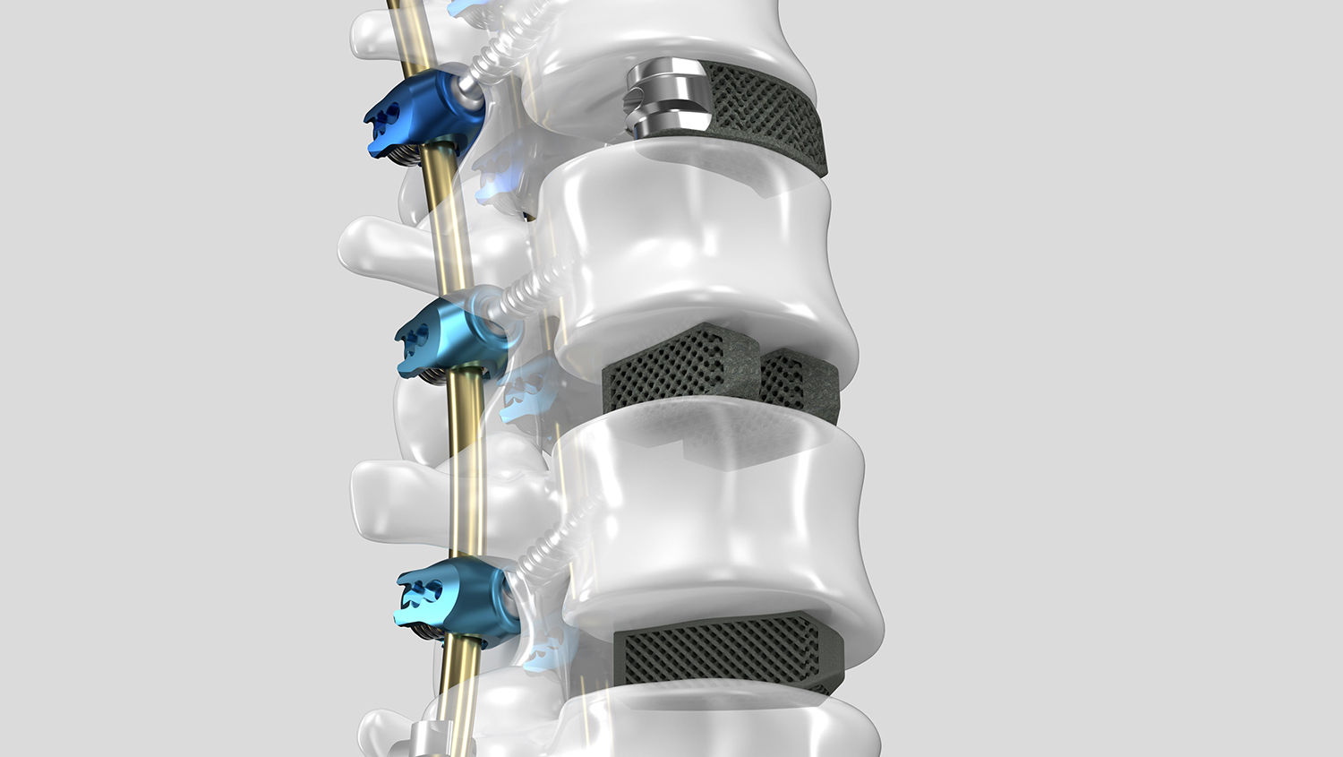 Ennovate® Thoracolumbar & Sacropelvic z urządzeniami do stabilizacji międzytrzonowej AESCULAP® 3D