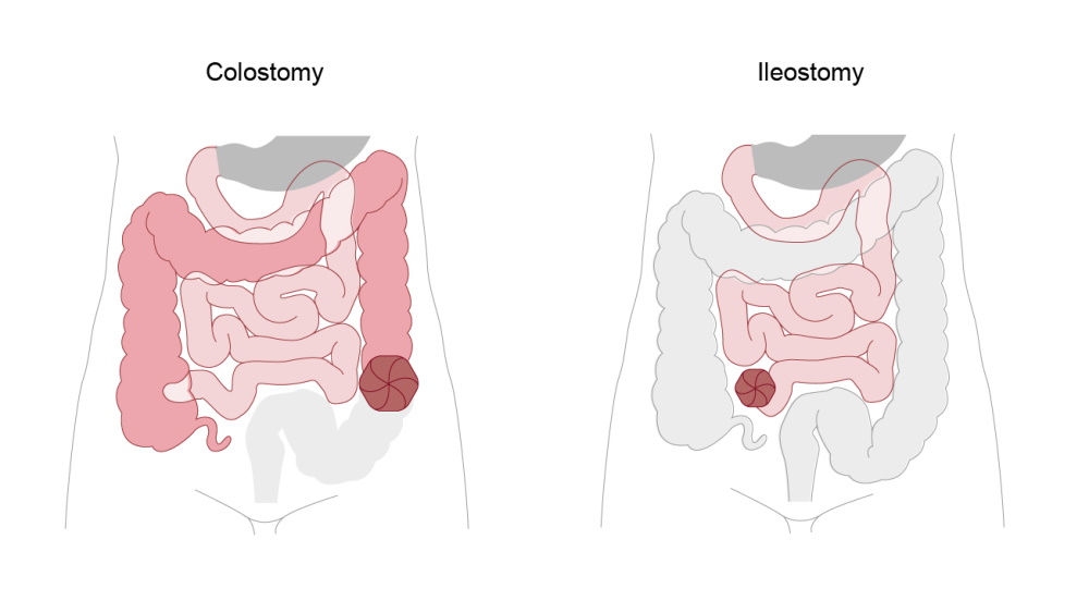 ilustracja kolostomii i ileostomii