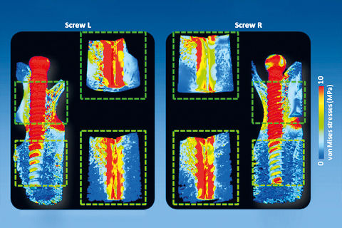 Analiza mikro-CT i mikro-FE mocowania śrubami pedikularnymi w różnych warunkach obciążenia