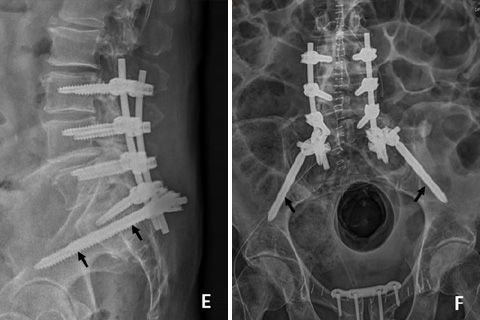 RTG kręgosłupa z implantami