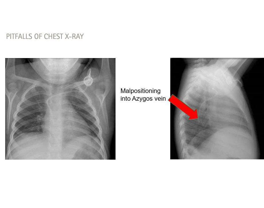 pułapki rentgenowskiej klatki piersiowej