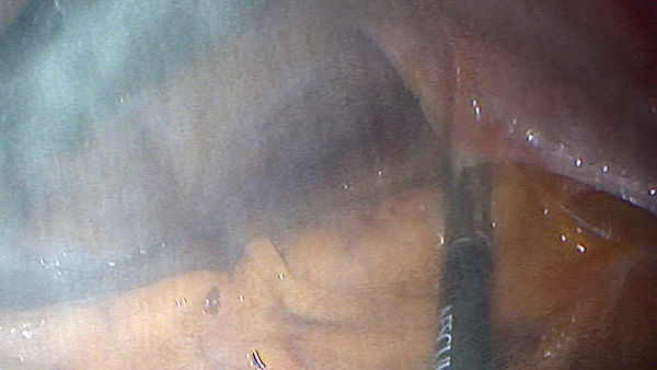 EinsteinVision® w chirurgii laparoskopowej z redukcją dymu