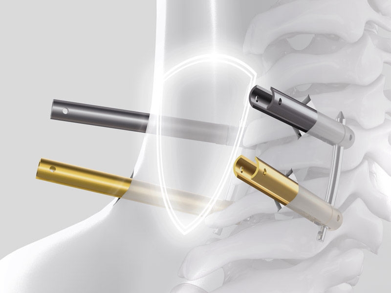 Ennovate® Cervical MIS – Minimal intervention. Enhanced protection.