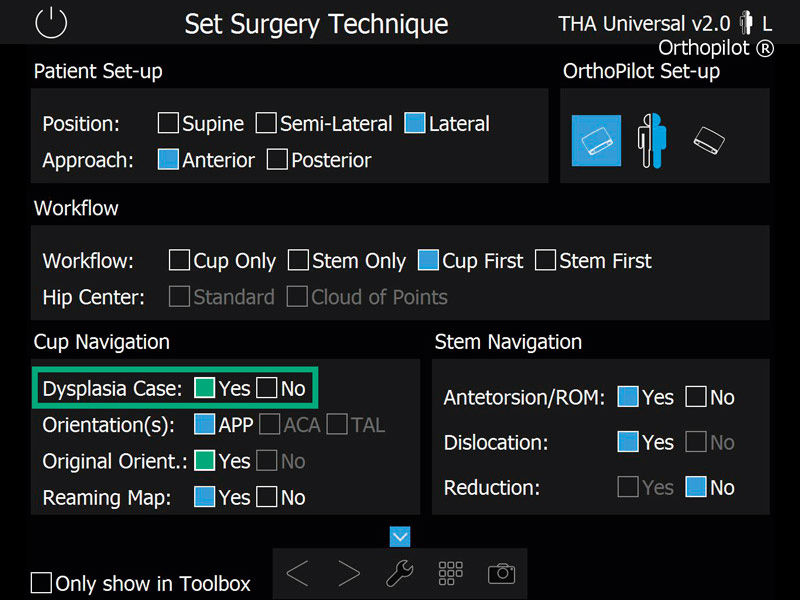 Zrzut ekranu Oprogramowanie nawigacyjne do dysplazji THA do artroplastyki stawu biodrowego