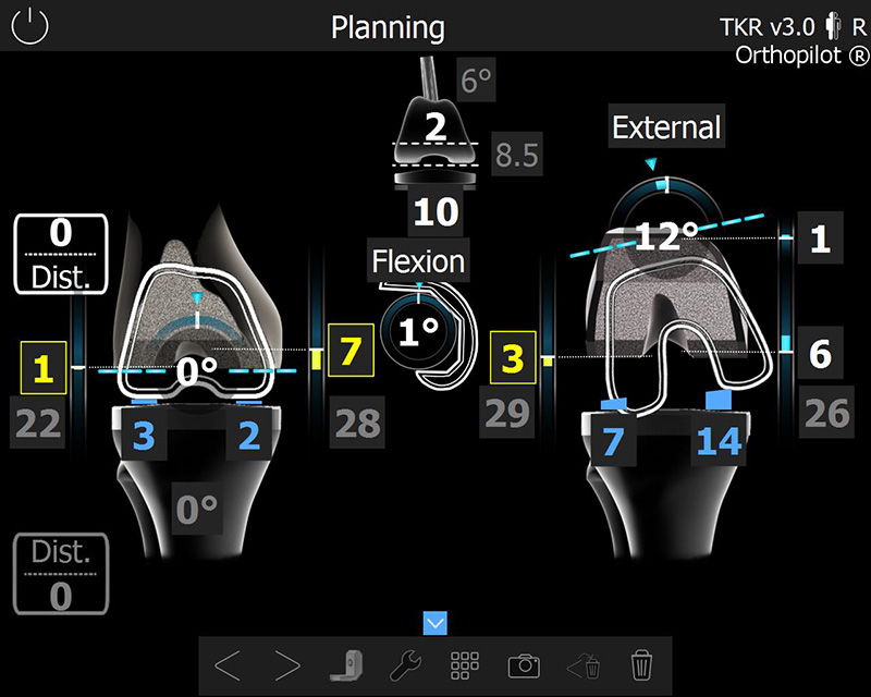 Zrzut ekranu z oprogramowania OrthoPilot® TKR - planowanie cięcia i augmentacji kości udowej