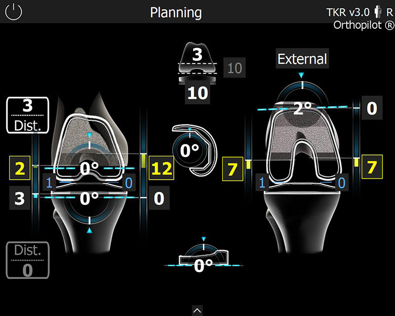 Zrzut ekranu oprogramowania OrthoPilot® TKR - Planowanie