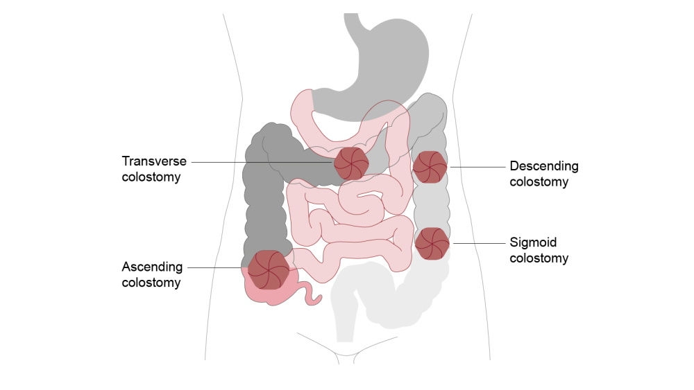 Ilustracja kolostomii poprzecznej, malejącej, wznoszącej i sigmoidalnej