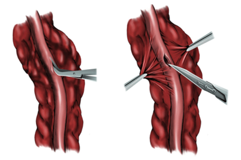 CABG Arteriortomy 