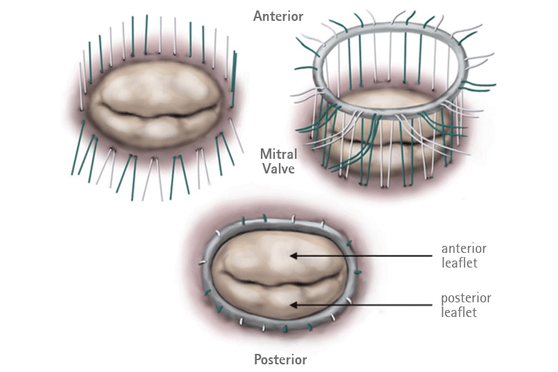 Annuloplasty