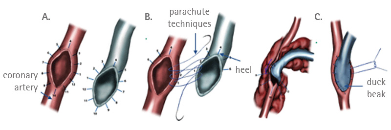 Distal anastomosis technique