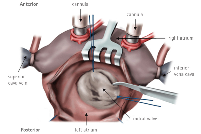 Excision of valve leaflets