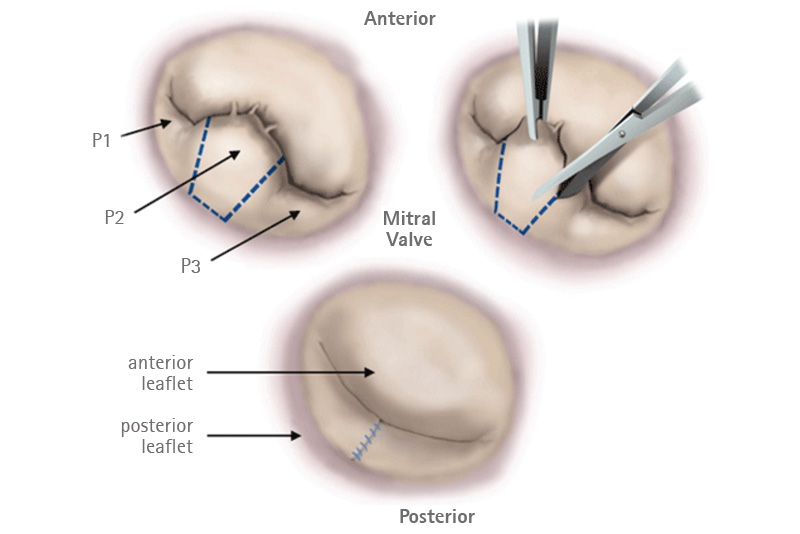 Mitral Posterior leaflet quadrangular resection