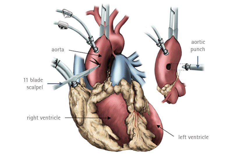 Proximal anastomosis technique