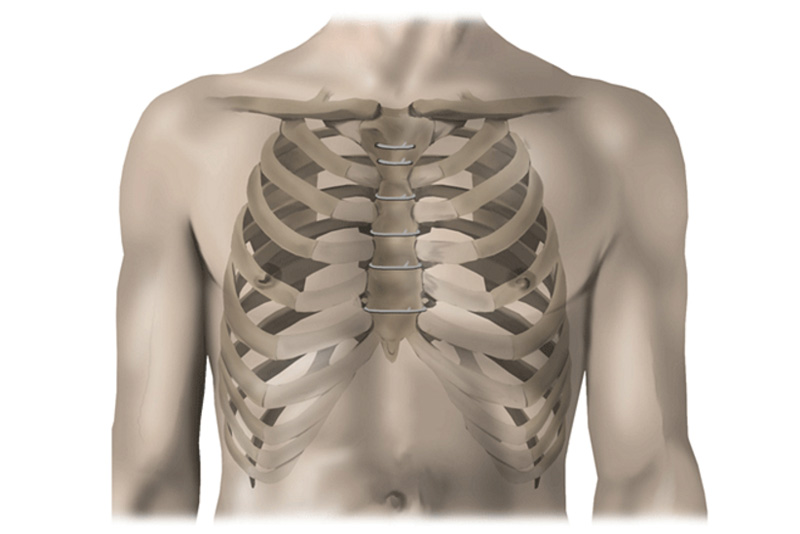 Sternal Closure