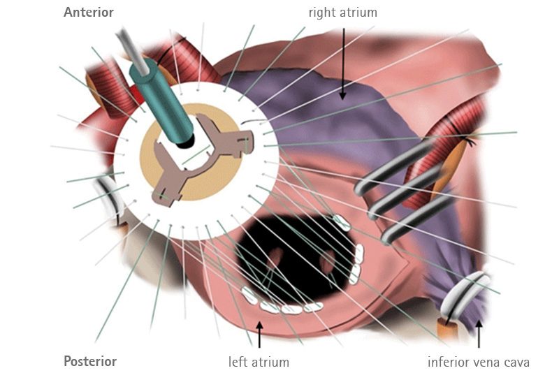 Implant of the valve