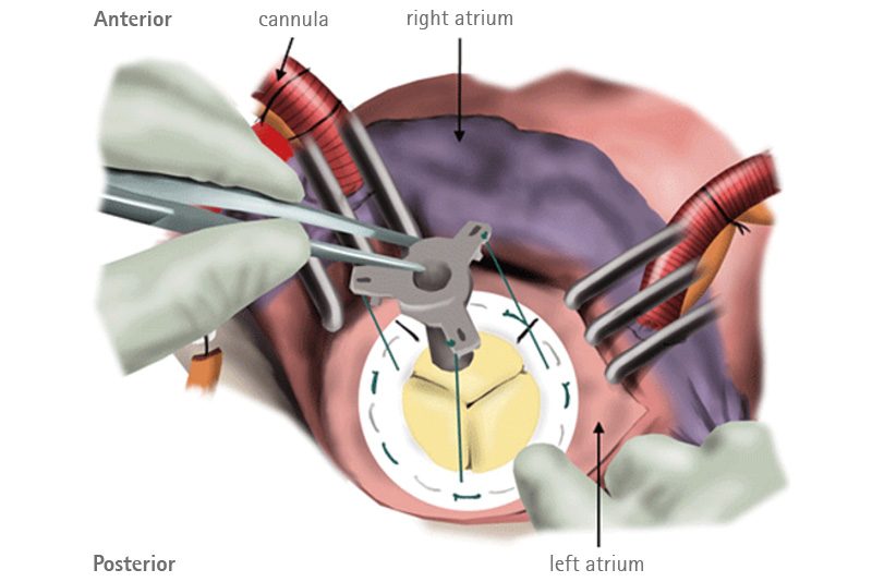 Implant of the valve II