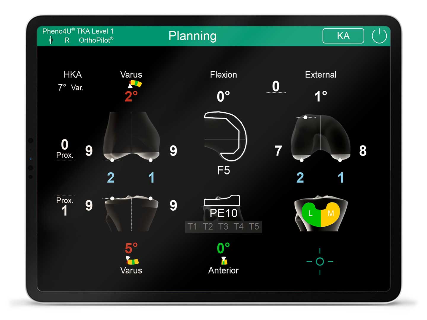 Ekran oprogramowania nawigacyjnego OrthoPilot Elite Pheno4U TKA Level 1
