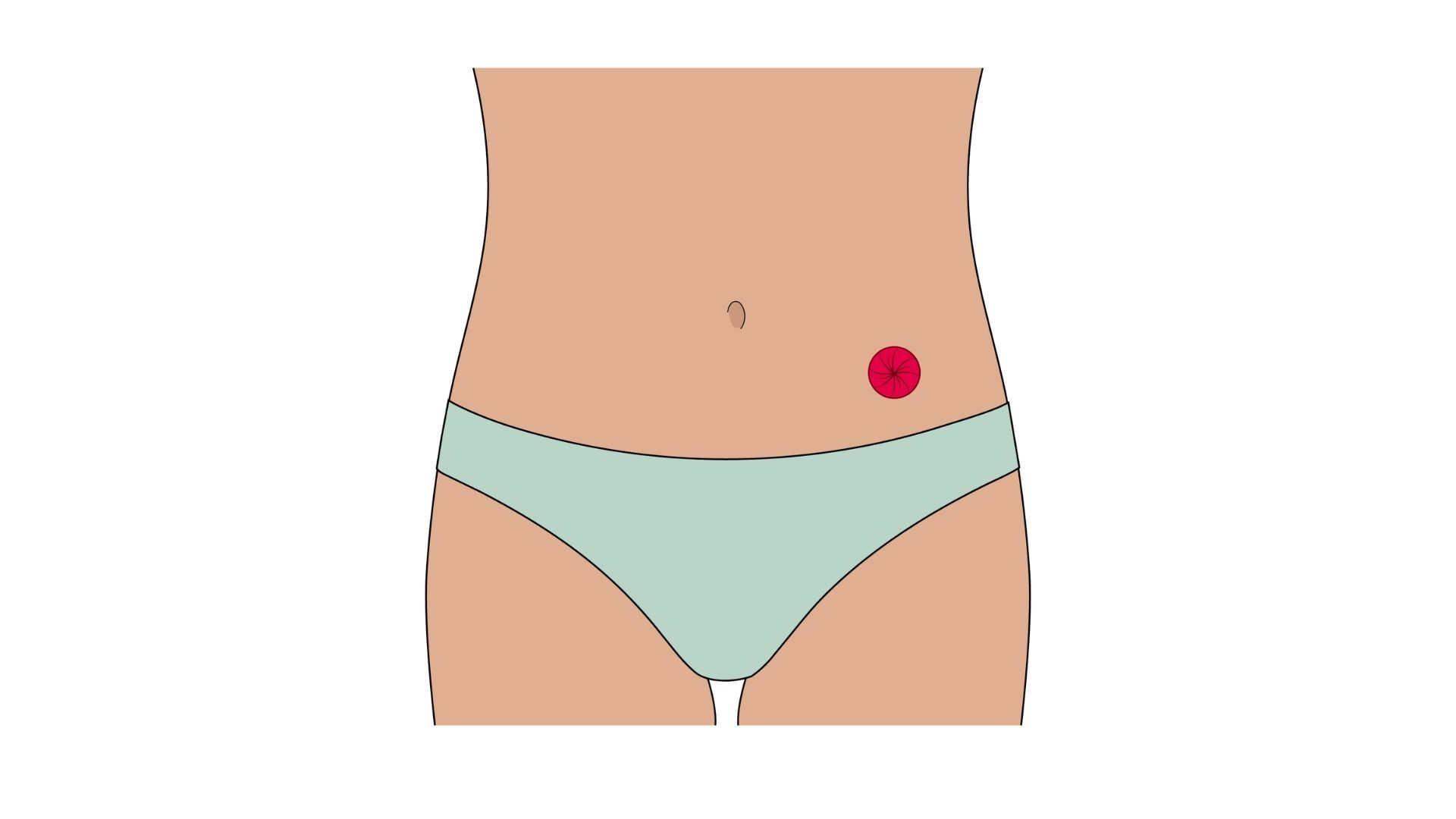  Ilustracja anatomiczna przedstawiająca kolostomię w widoku wewnętrznym. Widoczne jest połączenie stomii (zaznaczonej na czerwono) z okrężnicą zstępującą, wyprowadzoną bezpośrednio na powierzchnię brzucha. Dolna część jelita, znajdująca się poniżej stomii i wyłączona z pasażu treści jelitowej, została przedstawiona w stonowany sposób, aby uwidocznić przebieg kolostomii.