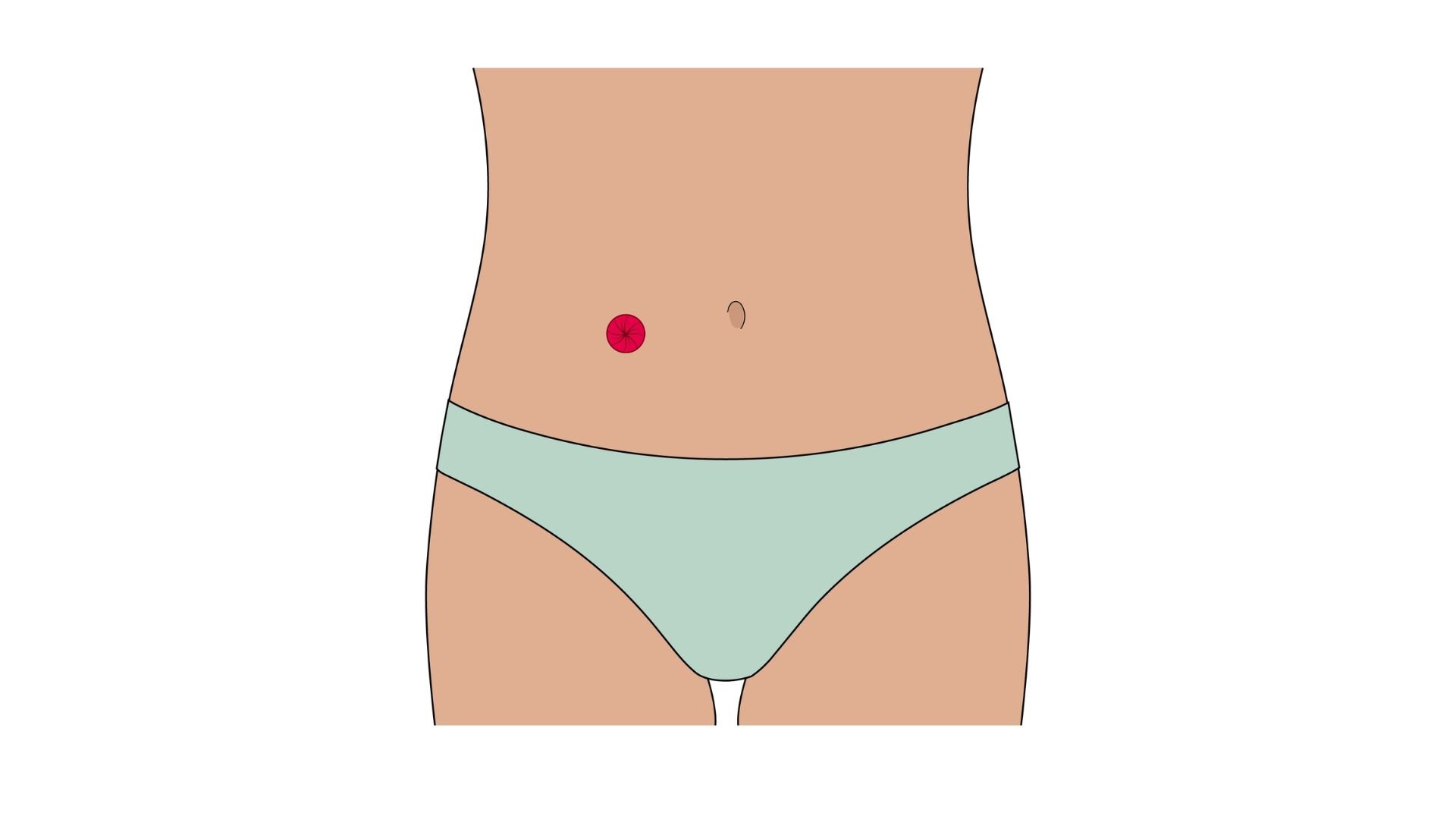  Ilustracja anatomiczna przedstawiająca ileostomię w widoku wewnętrznym. Widoczne jest połączenie stomii (zaznaczonej na czerwono) z jelitem cienkim (jelitem krętym), które zostało wyprowadzone bezpośrednio na powierzchnię brzucha. Całe jelito grube przedstawiono w stonowany sposób, aby wyraźnie pokazać przebieg ileostomii i drogę odprowadzania treści jelitowej.