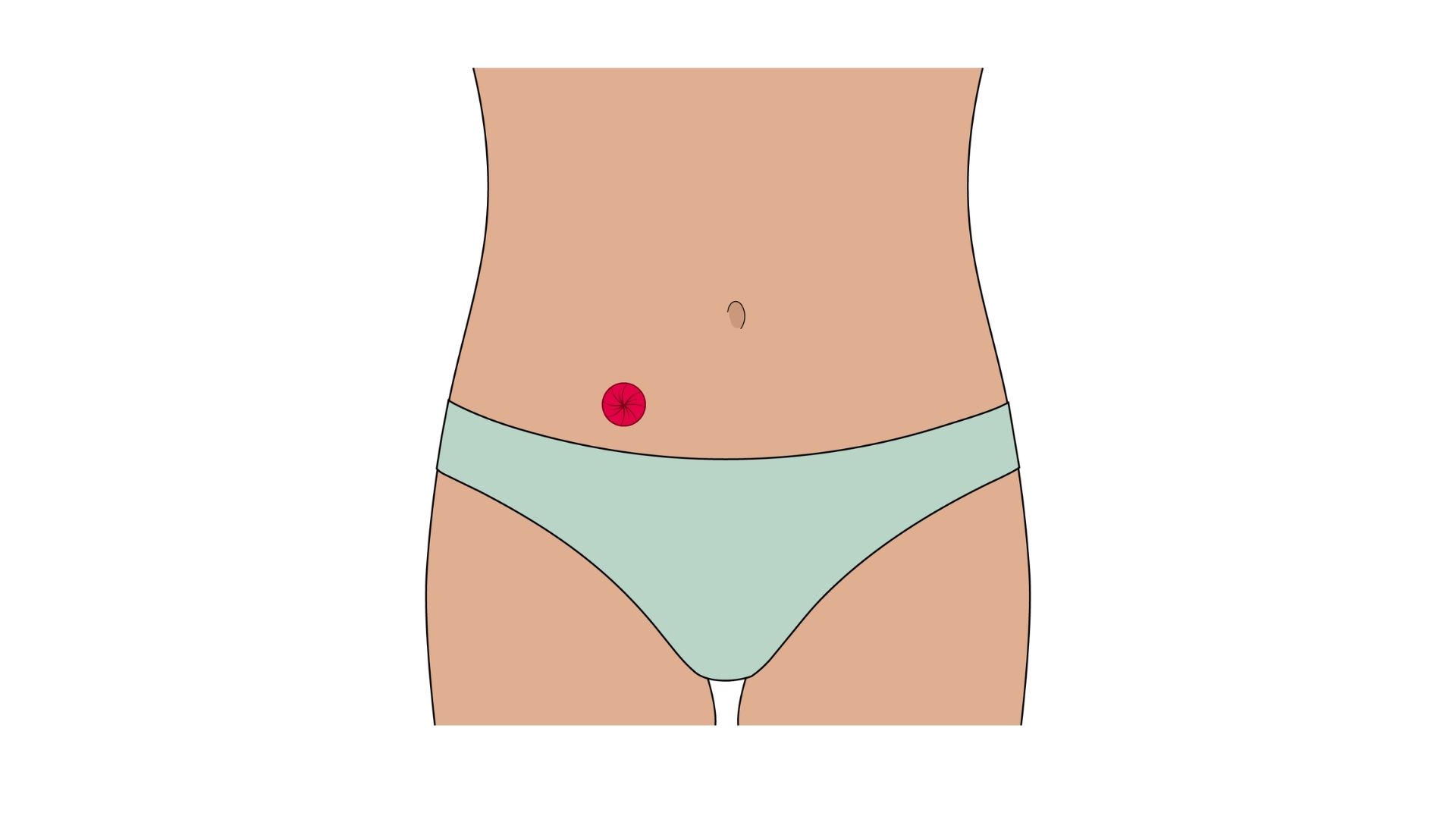 Ilustracja anatomiczna przedstawiająca urostomię w widoku wewnętrznym. Widoczne są obie nerki oraz moczowody połączone z wyizolowanym odcinkiem jelita cienkiego (przewodem jelitowym), który tworzy urostomię. Stomia została zaznaczona na czerwono na powierzchni brzucha. Przewód pokarmowy przedstawiono w stonowany sposób, aby podkreślić budowę układu moczowego oraz drogę odprowadzania moczu.